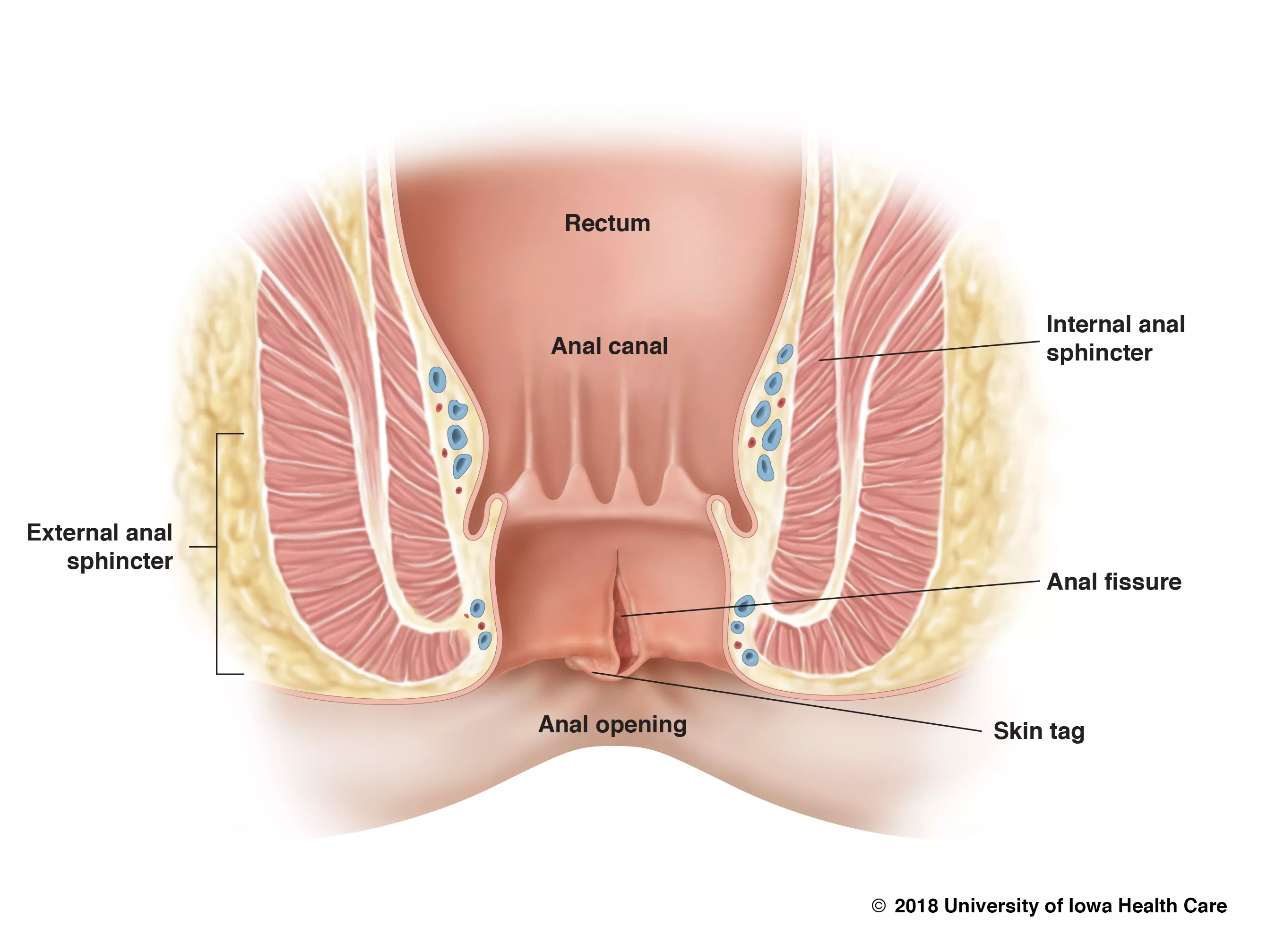 What Is Anal Fissure  ? How Is An Anal Fissure Treated?